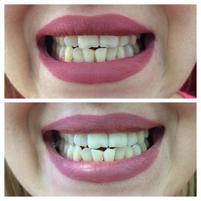 Фото 13171058 в коллекции Косметическое отбеливание зубов до и после - White&smile - отбеливание зубов