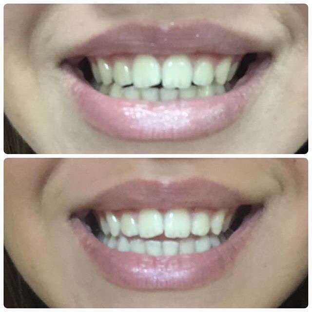 Фото 13171062 в коллекции Косметическое отбеливание зубов до и после - White&smile - отбеливание зубов