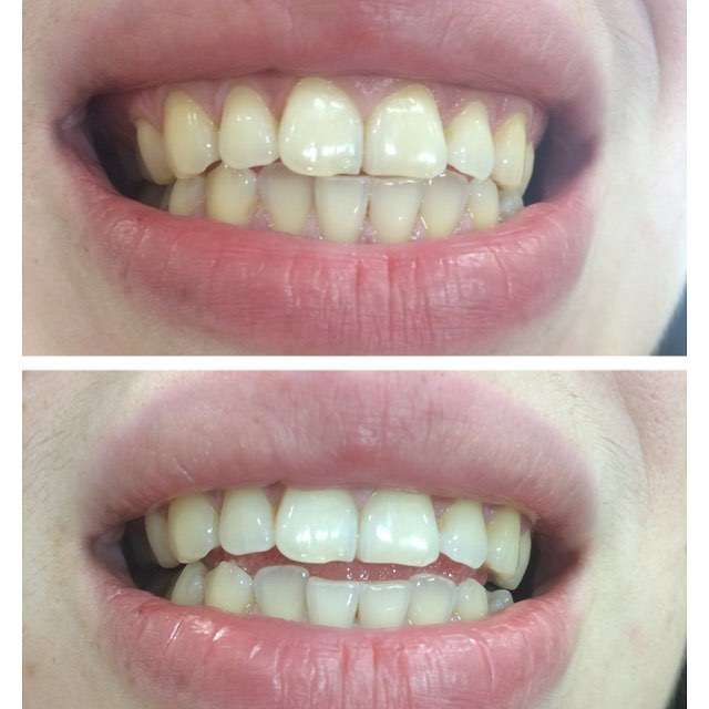 Фото 13171068 в коллекции Косметическое отбеливание зубов до и после - White&smile - отбеливание зубов