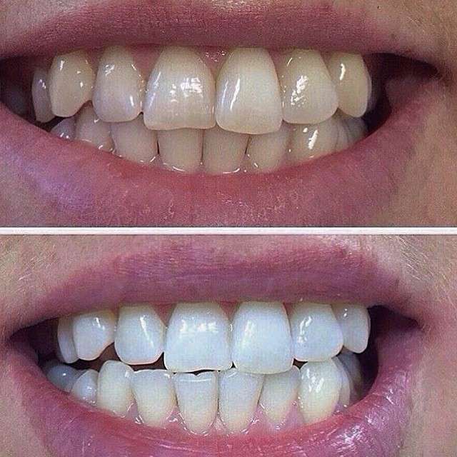 Фото 13171072 в коллекции Косметическое отбеливание зубов до и после - White&smile - отбеливание зубов